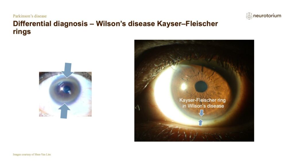 Differential diagnosis – Wilson’s disease Kayser–Fleischer rings
